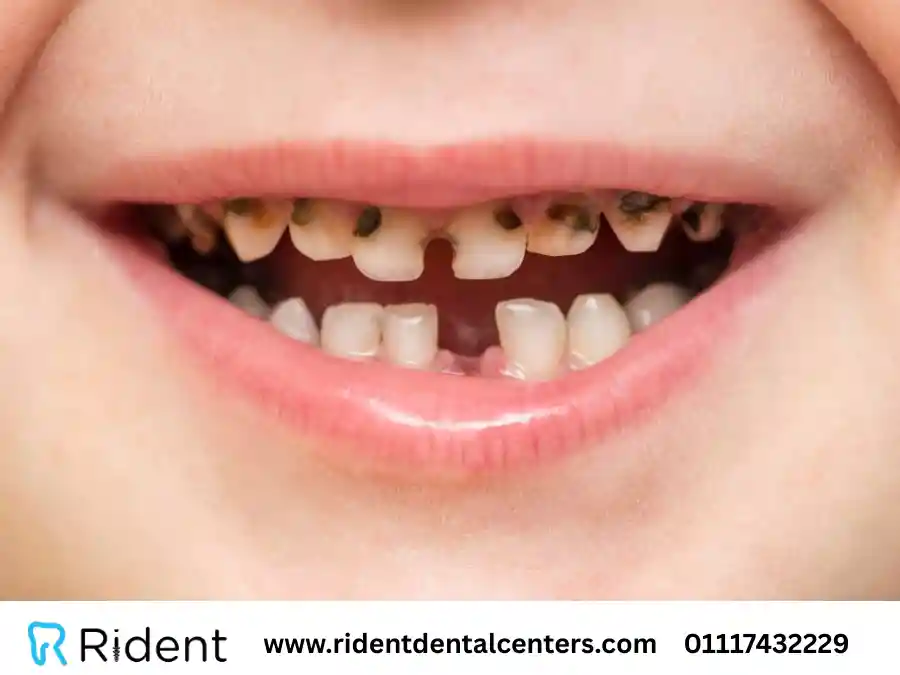 أهم طرق علاج تسوس الاسنان عند الاطفال